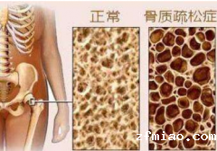 骨密度正常值是多少?超声骨密度仪生产厂家给你详细解答