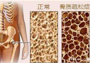 骨密度正常值是多少？超声骨密度仪生产厂家给你详细解答