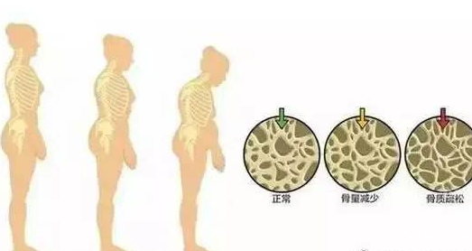 超声【骨密度仪】生产厂家新利18体育娱乐app菲律宾提醒骨质疏松症不容小觑