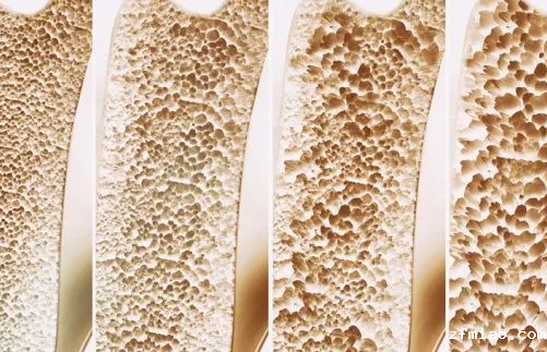 【超声骨密度仪】生产厂家国康提示老了与患骨质疏松相关的因素！