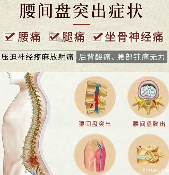 骨密度分析仪厂家提示腰间盘突出，如何躺比较合适？