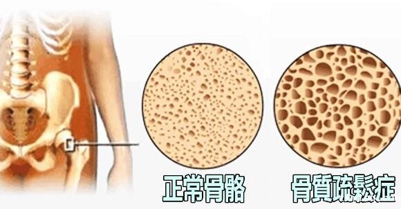 超声骨密度仪提示骨质疏松来的悄无声息测一测骨头的密度防患于未然 超声骨密度仪提示骨质疏松来的悄无声息测一测骨头的密度防患于未然