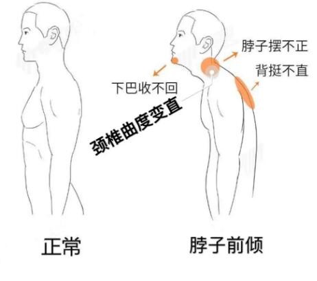 超声骨密度仪提醒颈椎前倾该怎么办?发现的问题立即调理 超声骨密度仪提醒颈椎前倾该怎么办?发现的问题立即调理