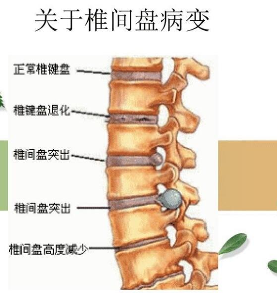 今日关注:超声骨密度仪品牌国康剖析腰疼是腰椎间盘突出症仍是腰肌劳损?
