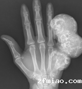 程序员手疼7年发现骨瘤!骨密度检测仪器提醒小心这些潜在的肿瘤…