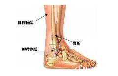 骨密度仪生产厂家解析撕脱骨折的治疗方式跟全层撕裂治疗类似