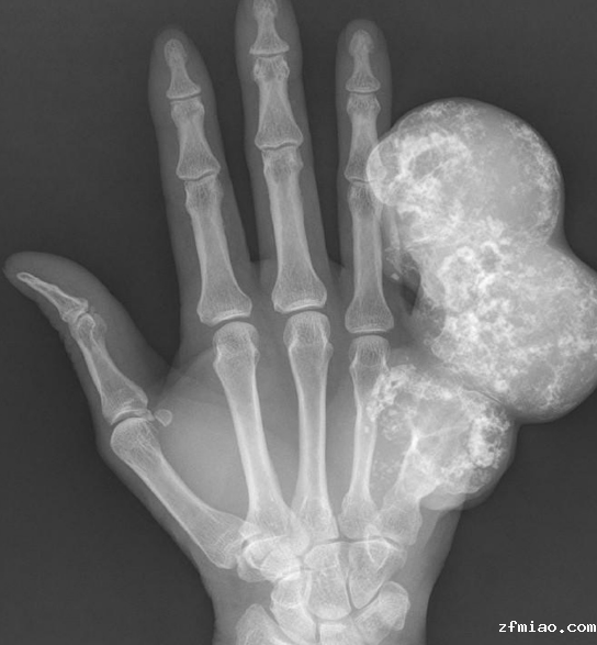 程序员手疼7年发现骨瘤!骨密度检测仪器提醒小心这些潜在的肿瘤…